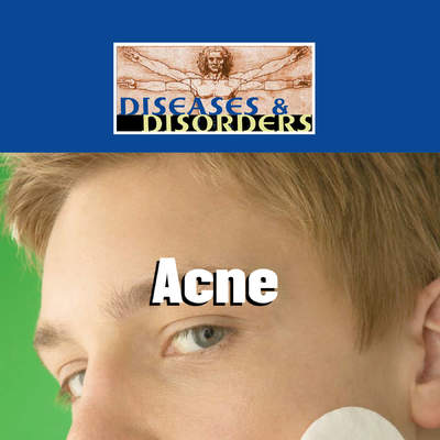 Acne Acne