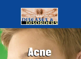 Acne Acne