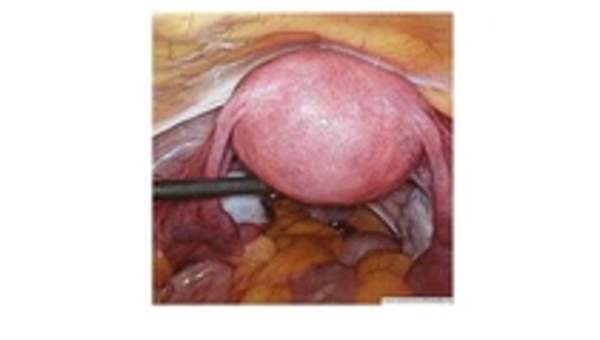 Imagen real del útero Imagen real del útero