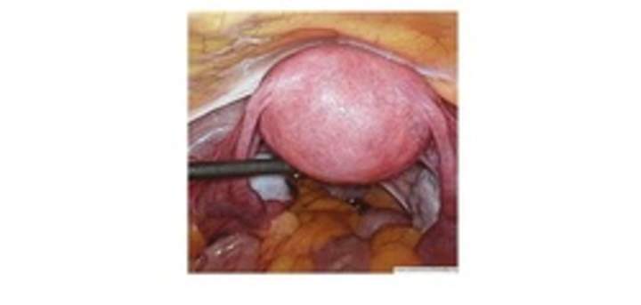 Imagen real del útero Imagen real del útero