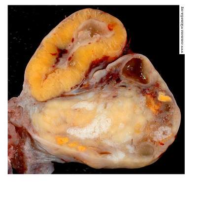 Ovarios de una mujer de 46 años Ovarios de una mujer de 46 años