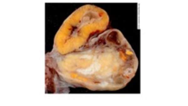 Ovarios de una mujer de 46 años Ovarios de una mujer de 46 años