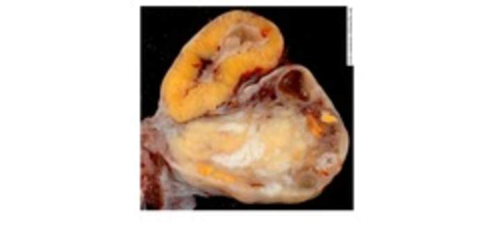 Ovarios de una mujer de 46 años Ovarios de una mujer de 46 años