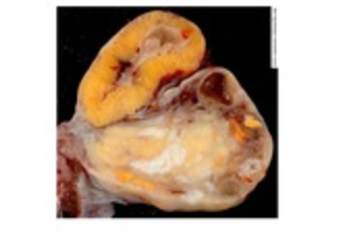 Ovarios de una mujer de 46 años Ovarios de una mujer de 46 años