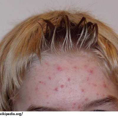 Imagen de acne Imagen de acne