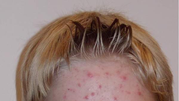 Imagen de acne Imagen de acne