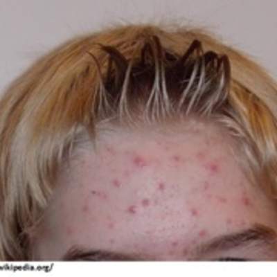 Imagen de acne Imagen de acne
