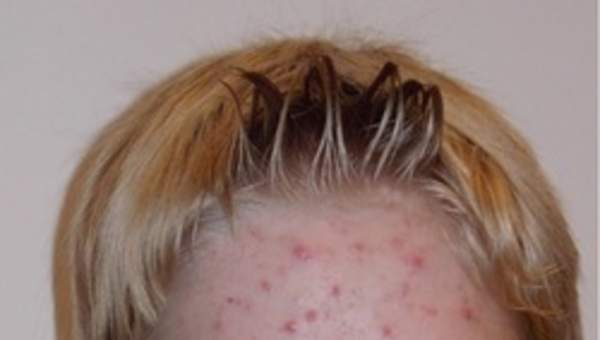 Imagen de acne Imagen de acne