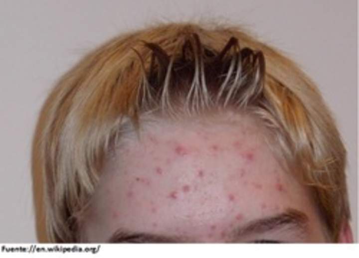 Imagen de acne Imagen de acne
