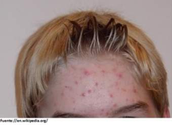 Imagen de acne Imagen de acne