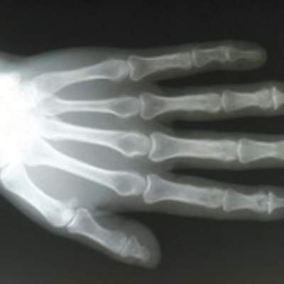 Radiografía de una mano Radiografía de una mano