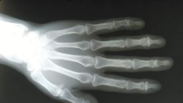 Radiografía de una mano Radiografía de una mano